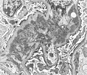 M,21y. | IgA nephropathy (Berger disease)